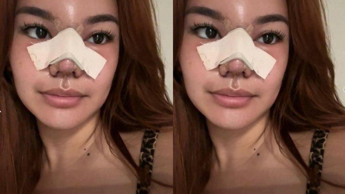 Shafa Harris oplas hidung dengan mengambil sebagian tulang iga dari tubuhnya