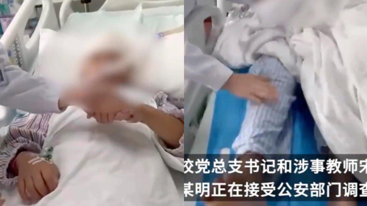 Siswi SD di China menerima perawatan setelah tulang tengkoraknya retak
