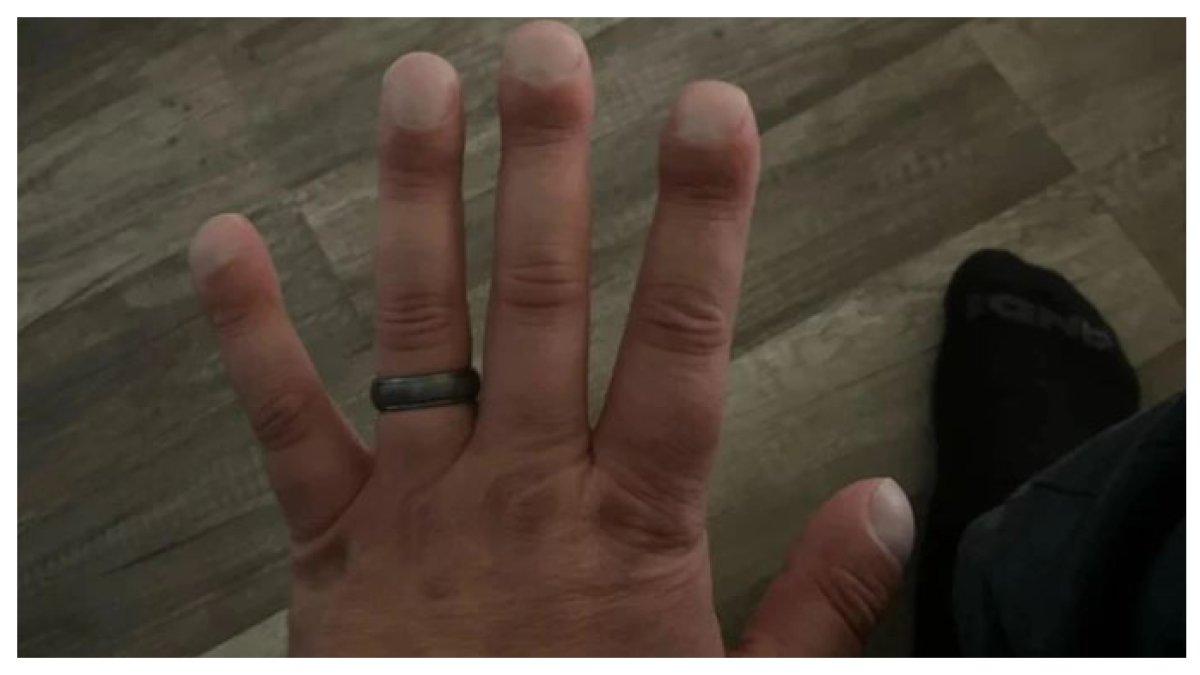 UJUNG JARI DAN KUKU MENONJOL - jika ujung jari dan kuku Anda tiba-tiba mulai menonjol,Ujung jari besar dan menonjol yang mungkin merah atau hangat saat disentuh, bisa menjadi tanda penyakit jantung atau paru-paru