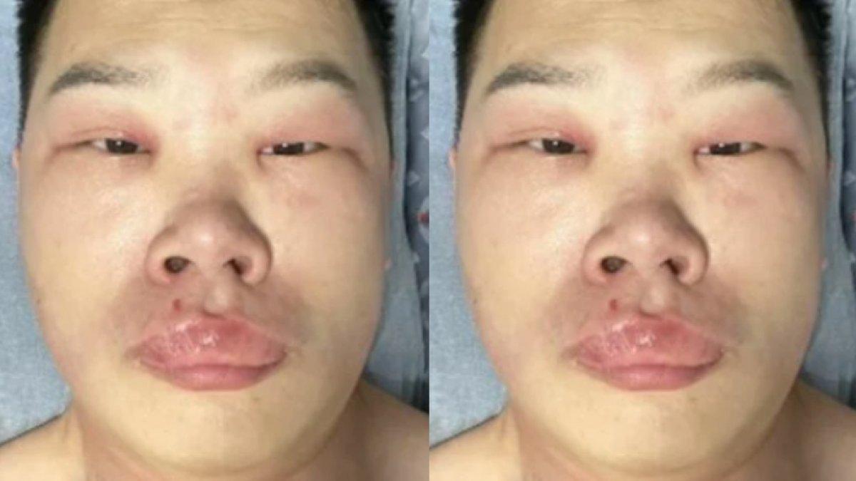 Wajah Zeng menjadi bengkak hingga membuat matanya sulit dibuka gara-gara keseringan ngupil.
