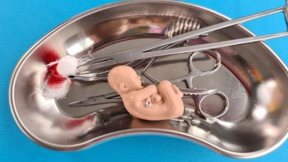 Ilustrasi aborsi.