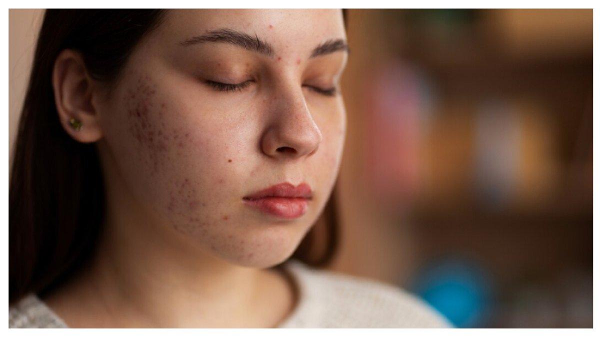 BINTIK PADA WAJAH -  vitamin D3 berkualitas tinggi yang dapat membantu meningkatkan elastisitas dan produksi kolagen di kulit Anda sambil mengurangi munculnya bintik-bintik gelap.