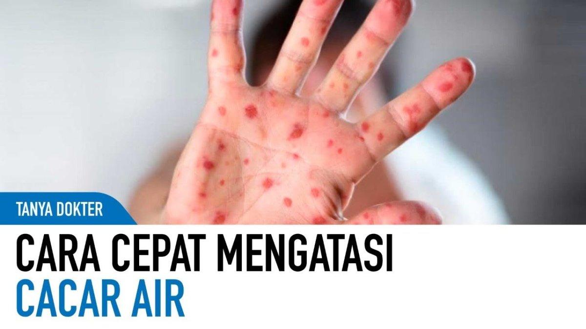 5 Cara Mudah dan Efektif Mengobati Cacar Air dengan Cepat, Salah