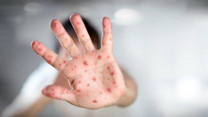 Ilustrasi cacar monyet atau monkeypox.