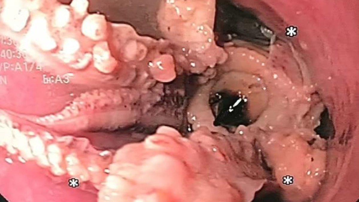 Hewan berkaki delapan itu tersangkut 5 cm dari persimpangan gastroesophageal, tempat kerongkongan dan perut bertemu.