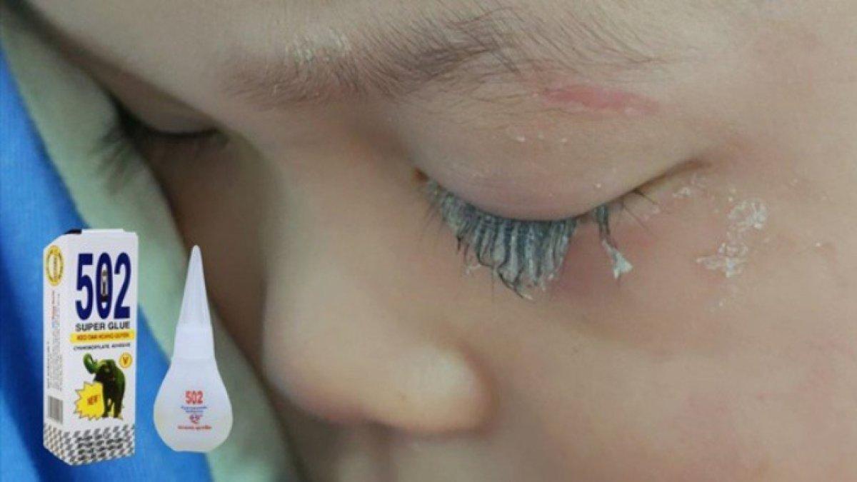 Ilustrasi mata anak kena lem super.