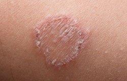 jamur cara mengatasi gatal