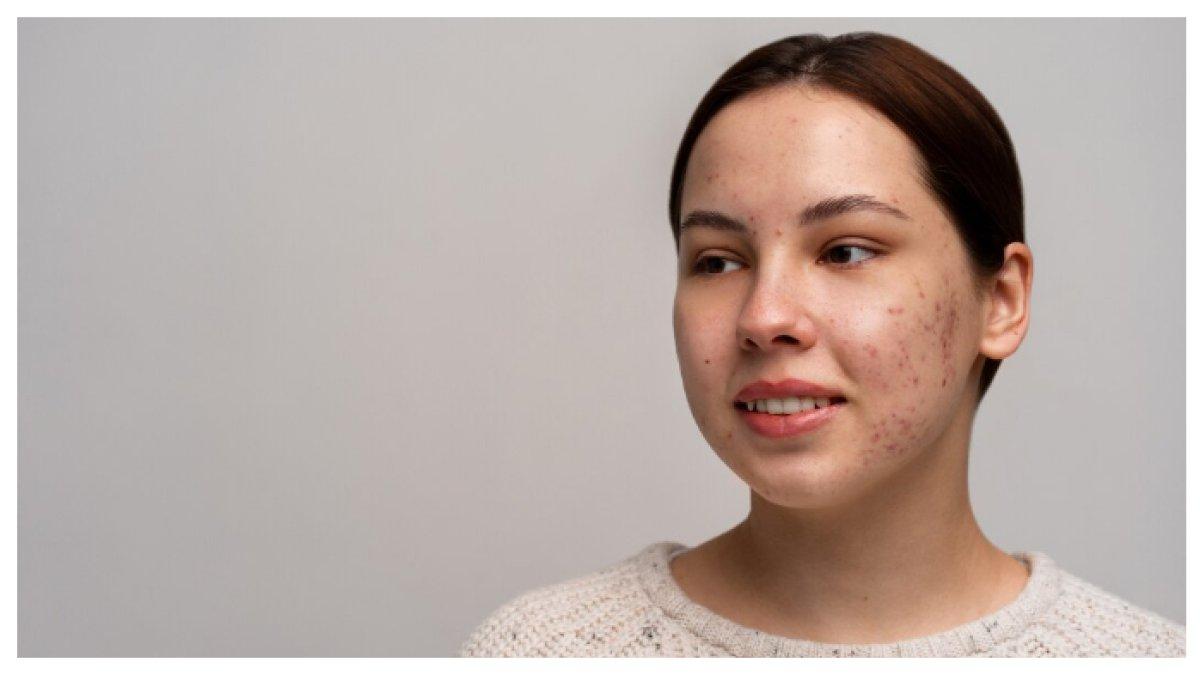 JERAWAT -  bakteri dapat penyebab wajah menjadi jerawat dan dapat menyumbat pori-pori pada wajah.