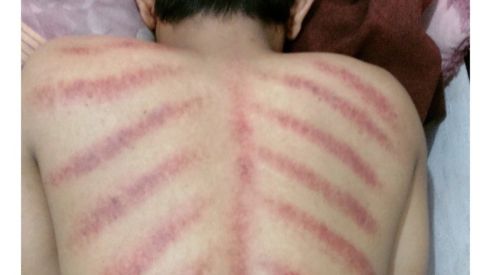 Kerokan untuk mengobati penyakit angin duduk