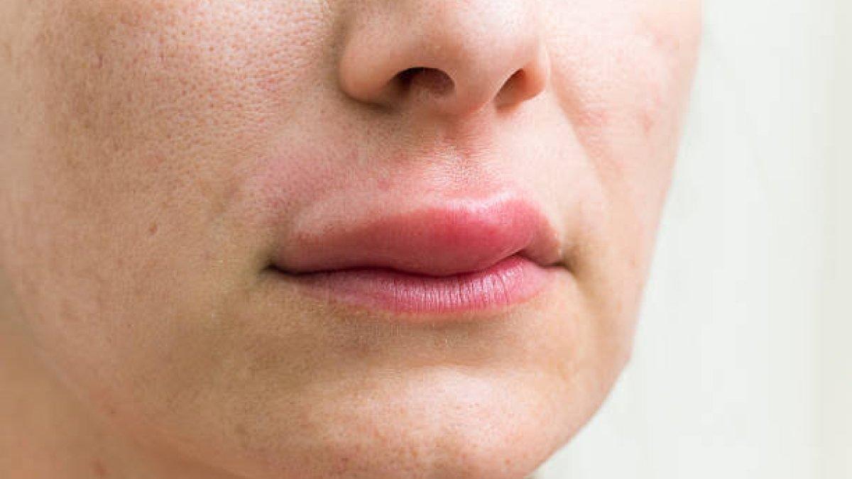 kompres bibir cara mengatasi