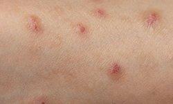 kulit tergeser cara mengatasi