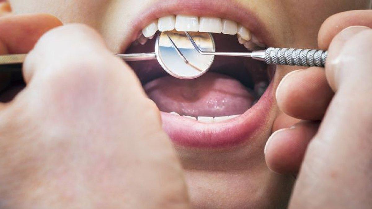 Menambal gigi dapat mengatasi gigi berlubang