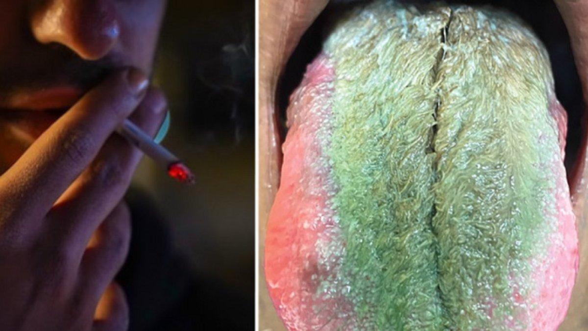 Penampakkan lidah perokok yang muncul bulu hijau di lidahnya.