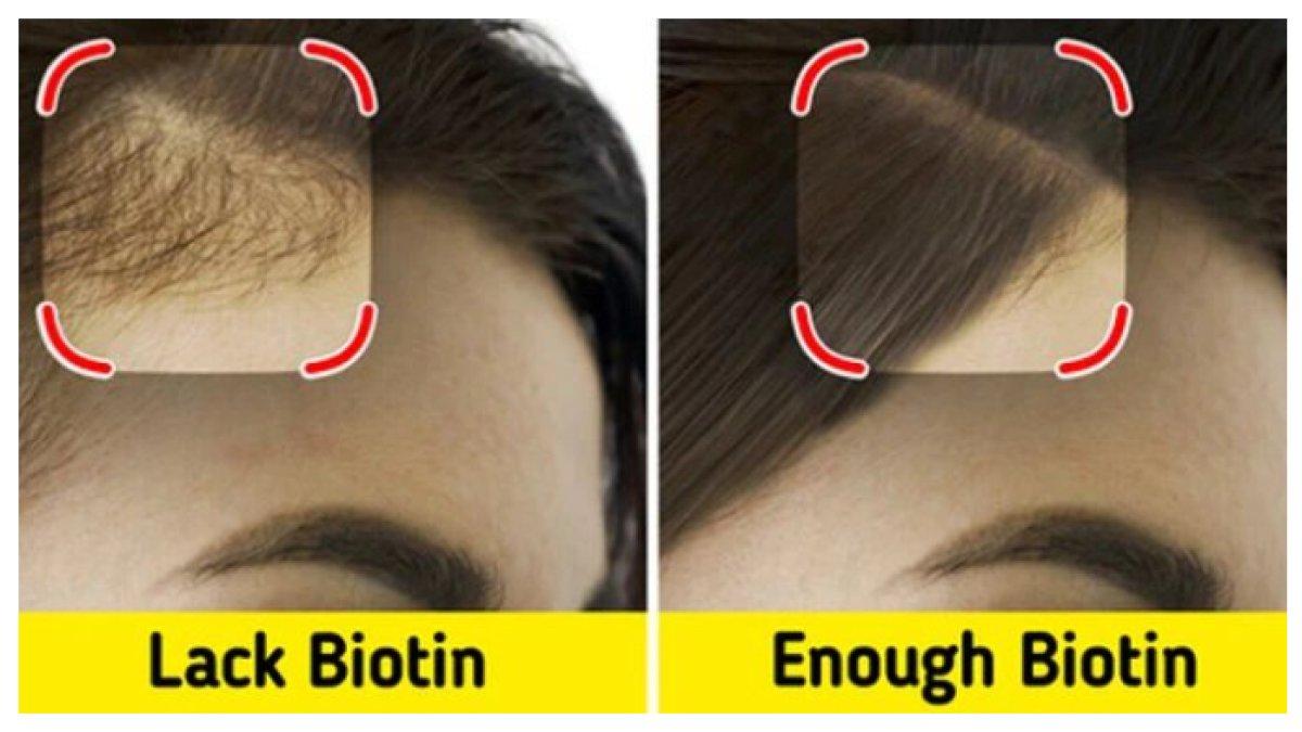 RAMBUT RONTOK - Biotin berperan penting dalam kesehatan rambut.