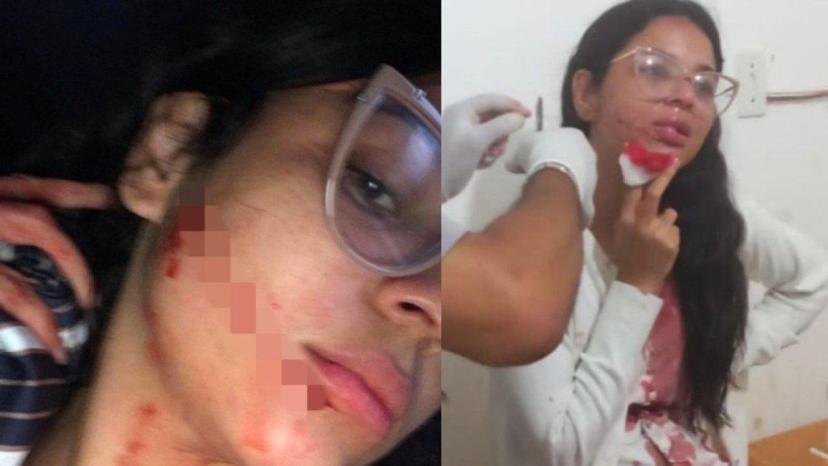 Selebgram syok melihat pipinya berdarah setelah terbangun dari tidur.