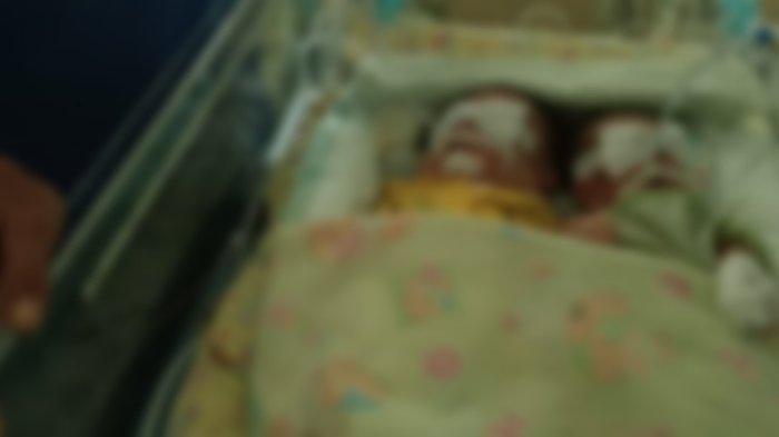 Bayi kembar siam asal Mamuju yang kini dirawat fdi RS Wahidin Sudirohusodo Makassar