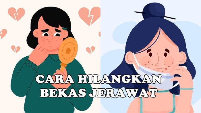 Cara Menghilangkan Bekas Jerawat dengan Metode yang Efektif, Wajah Kembali Bersih dan Terawat