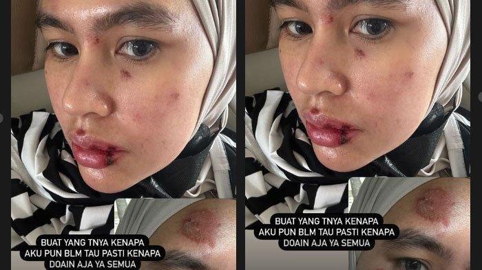 Kartika Putri Kini Muncul Beri Penjelasan Soal Penyakit Kulit Langka yang Dialaminya, Wajah Melepuh