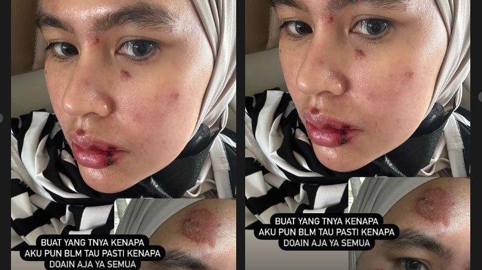 Kartika Putri membagikan kesedihannya atas kondisi wajah dan lidahnya yang melepuh tanpa sebab