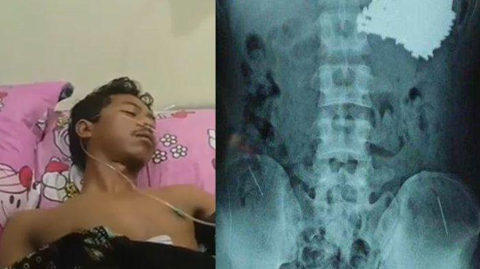 Kisah Pria Indramayu Jalani Operasi Ditemukan 70 Paku di Perut, ODGJ Sering Telan Benda Tak Wajar