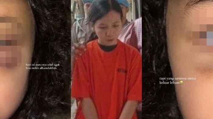 Kondisi terkini anak selebgram Emy Aghnia usai jadi korban penganiayaan suster berinisial IPS (27).