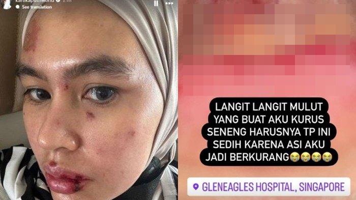 Kronologi Kartika Putri alami penyakit misterius hingga luka bakar, kini berobat ke Singapura.