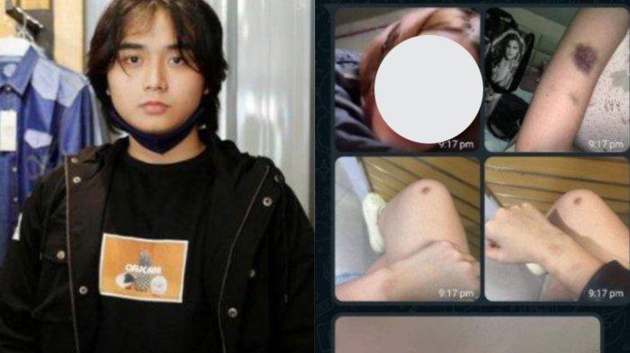 Kengerian sikap Leon Dozan yang diduga aniaya pacar hingga lebam. Kejar sampai ke toilet wanita hingga panjat dinding.