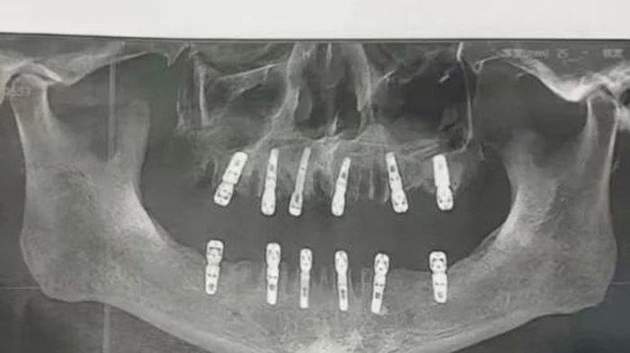Hasil CT scan 12 implan gigi dari pria tua di China yang sebelumnya 23 gigi telah dicabut | Pria Ini Meninggal Dunia Usai Cabut 23 Gigi dalam Satu Hari