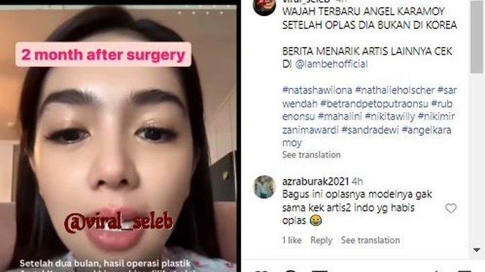 Potret cantik Angel Karamoy usai oplas
 