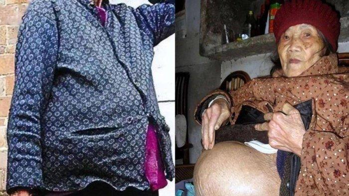 Kondisi perut Hoang Nghia Quan wanita 91 tahun hamil (kanan) ternyata simpan mayat janin