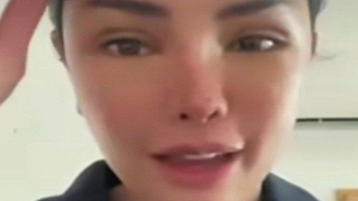 Wajah Nikita Mirzani pasca oplas di Korea diduga belum pulih sepenuhnya