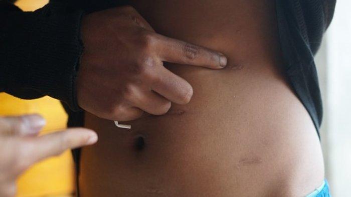 Wanita Nekat Jual Ginjal Gegara Terlilit Utang, Diiklankan di Facebook dengan Harga Rp 200 Juta