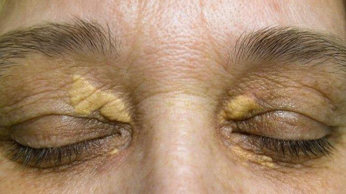 Ilustrasi Xanthelasma.