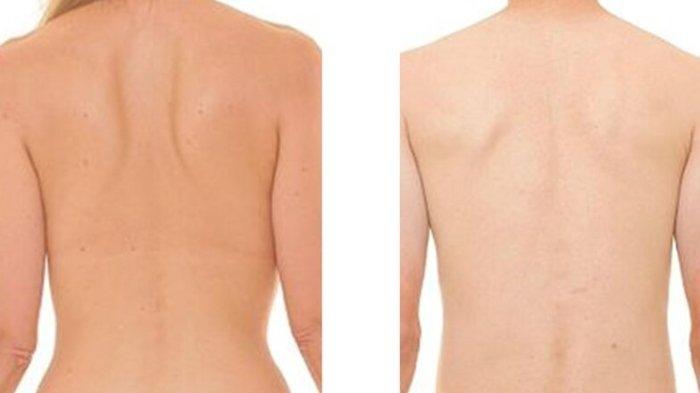 Gambaran punggung wanita dan pria. Viral seorang wanita yang ketiduran di kantor mengalami cedera punggung gegara ditepuk oleh teman kerjanya pakai jurus kung fu saat membangunkan.