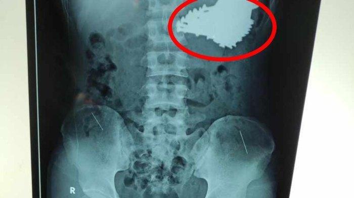 Hasil rontgen pria yang makan paku di Indramayu, Jawa Barat