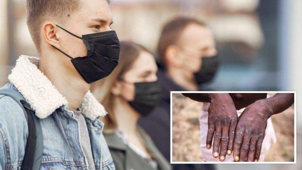 Ilustrasi monkeypox dan memakai masker.
