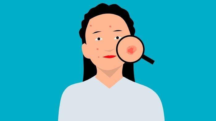 Ilustrasi wajah berjerawat.