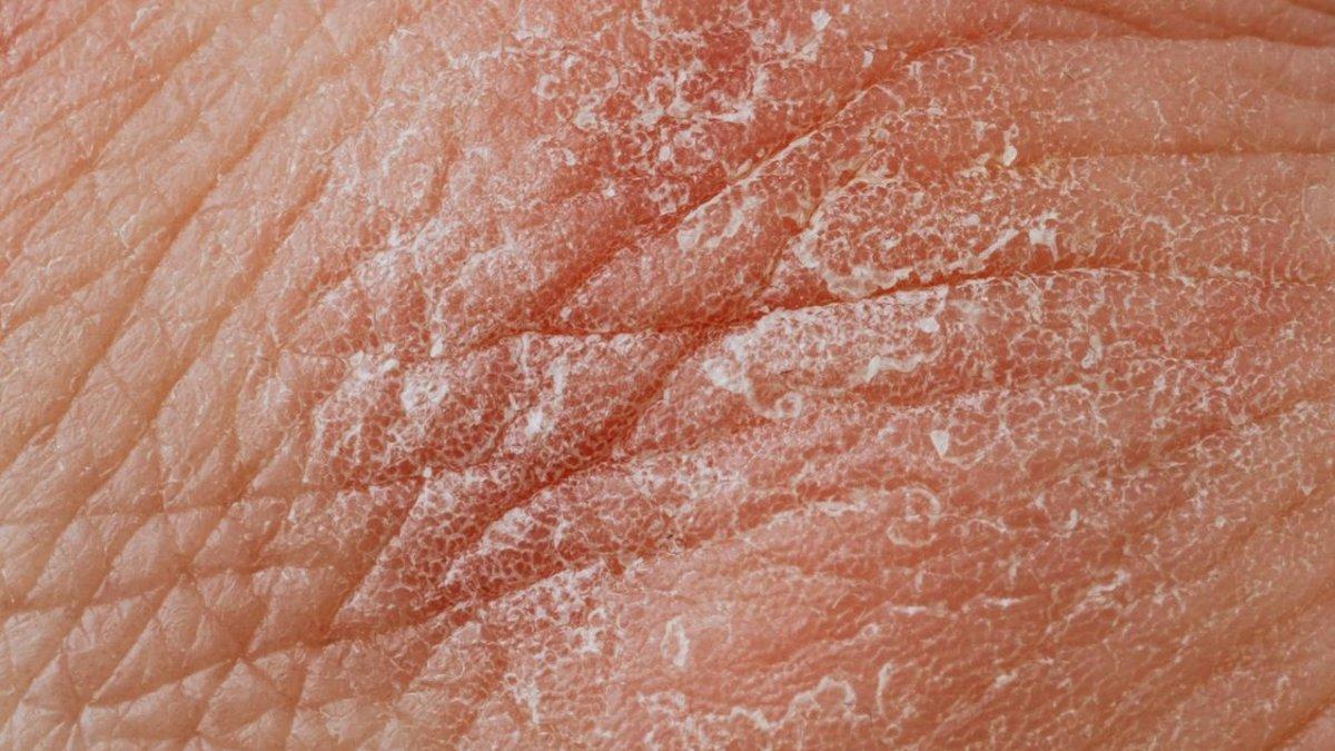 Kulit kering, satu tanda kekurangan vitamin D dalam tubuh.