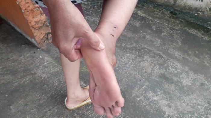 Penampakan luka-luka pada kaki yang dialami warga Pakansari, Kecamatan Cibinong, Kabupaten Bogor akibat diserang kucing oren galak, Minggu (28/1/2024).
