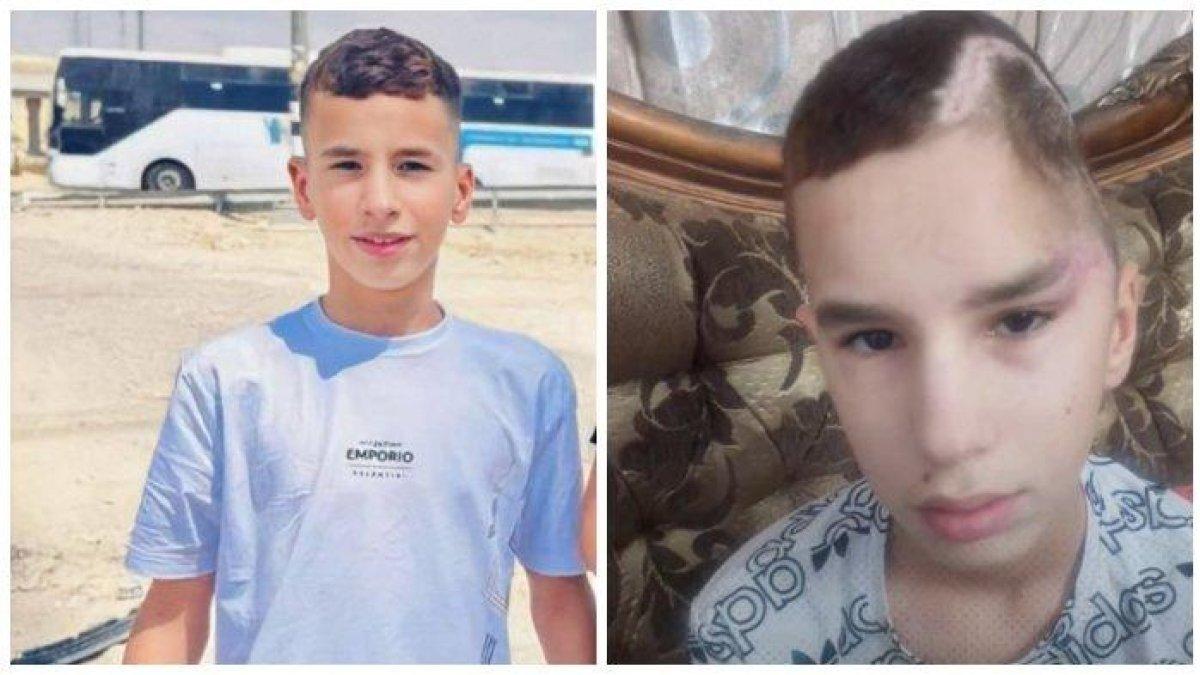 Abdul Rahman (14), tahanan Palestina yang dibebaskan oleh Israel pada Rabu (28/11/2023) dalam kesepakatan pertukaran sandera dan tahanan dengan kelompok bersenjata Hamas Palestina. Abdul Rahman kehilangan separuh tengkoraknya karena ditemak 30 kali oleh Israel sekitar 3 bulan lalu.