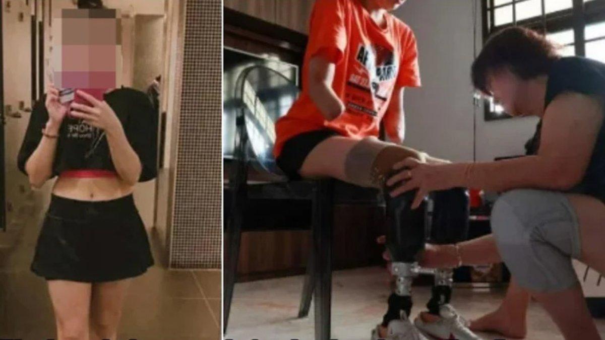 Ai Ling relakan tubuhnya diamputasi gegara infeksi bakteri a