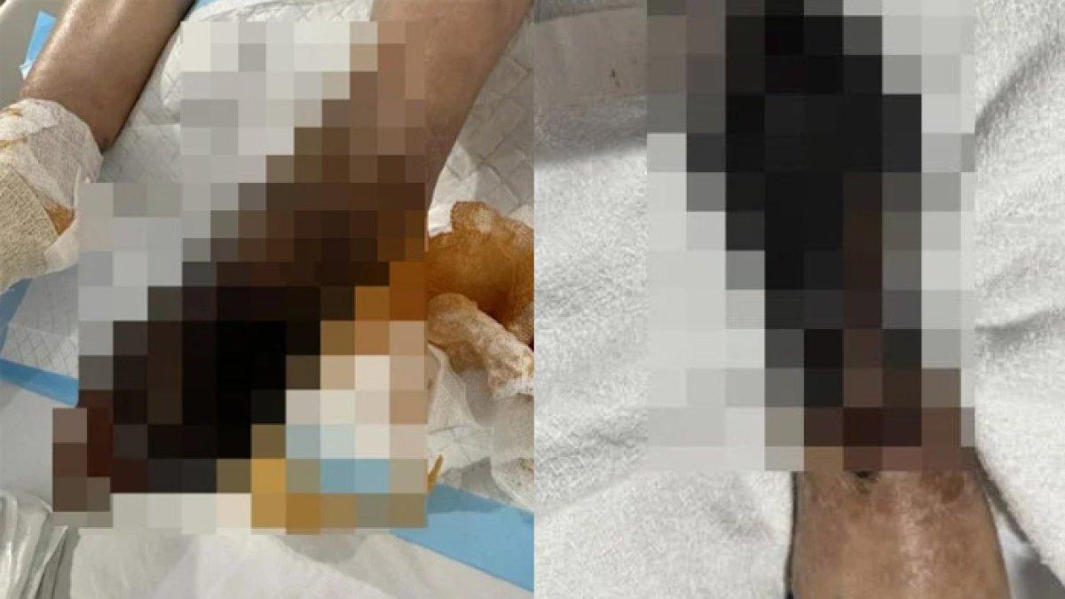 Ai Ling relakan tubuhnya diamputasi gegara infeksi bakteri