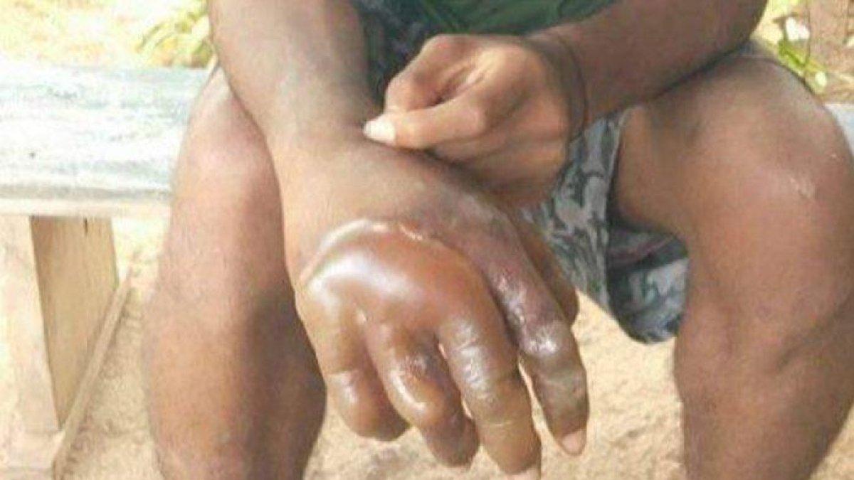 Aksi guru mencelupkan tangan siswanya ke air mendidih menjadi perhatian warganet.