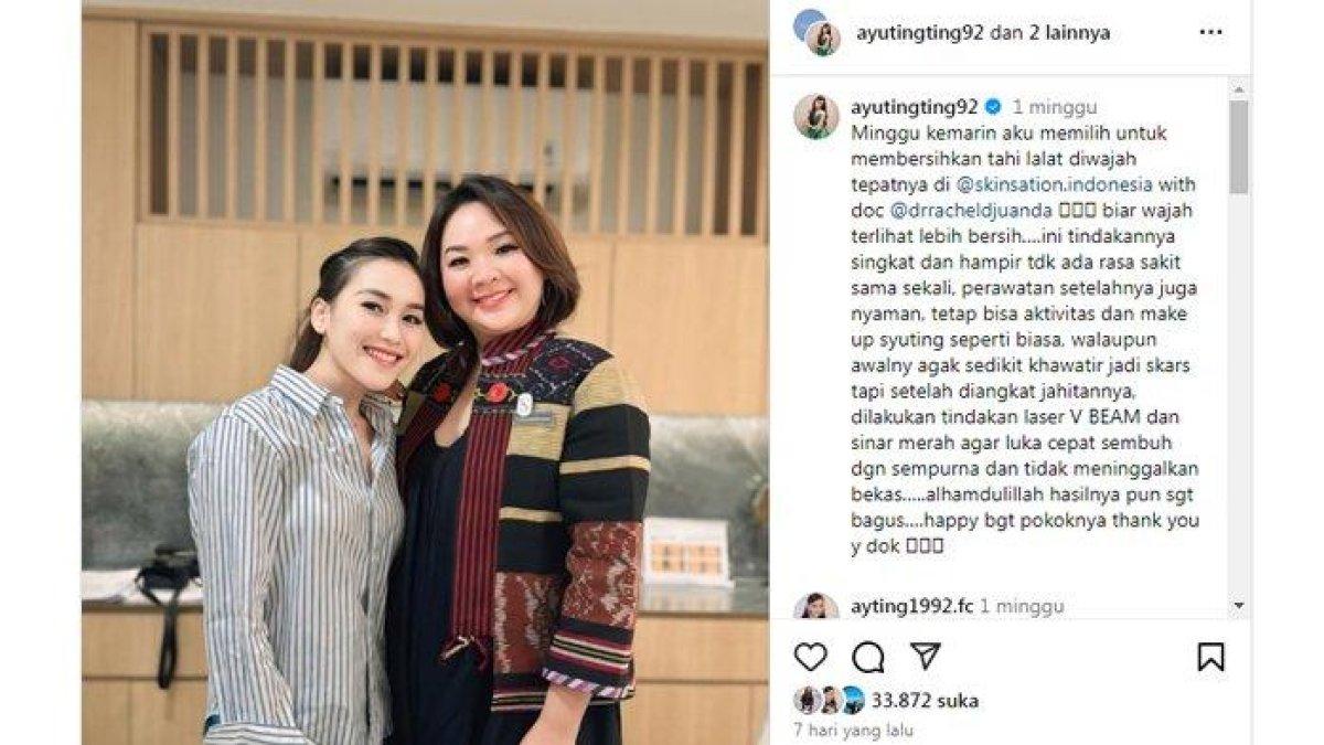 Ayu Ting Ting hapus tahi lalat usai batal nikah dengan Lettu Fardhana.