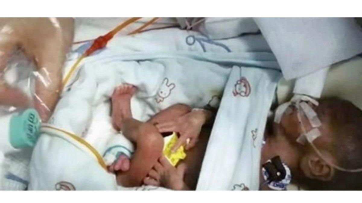 Bayi lahir dengan berat 6,5 ons.