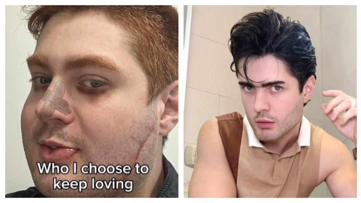 PASANGAN LAKUKAN OPLAS - Pasangan sama-sama memiliki hobi Oplas hingga habiskan Rp 570 Juta. Kini masih terus lakukan oplas demi hasil yang memuaskan.