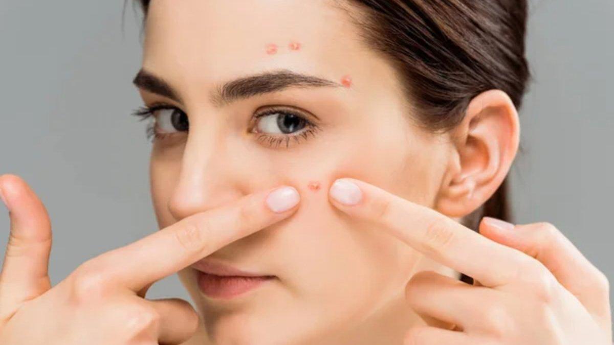 Berikut ini 3 tips mencegah jerawat muncul jelang menstruasi