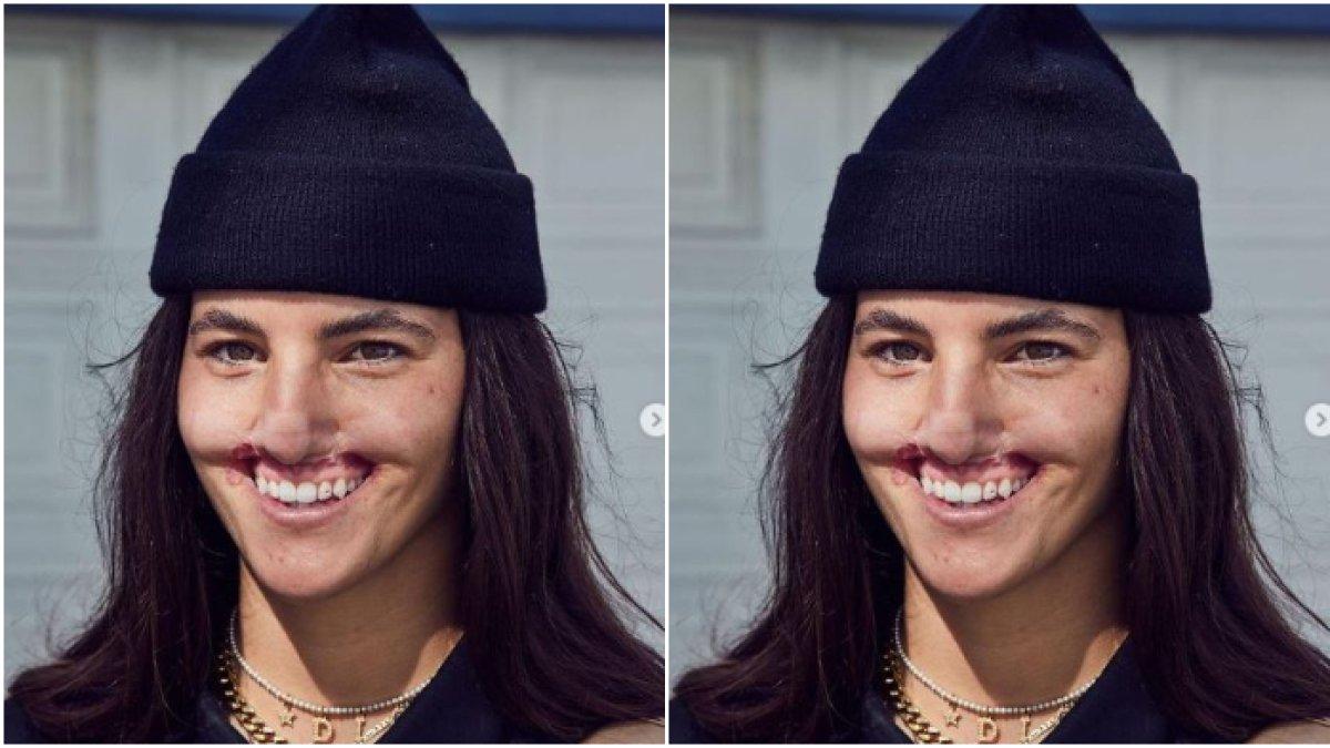 Bibir Brooklynnn remuk usai digigit anjing