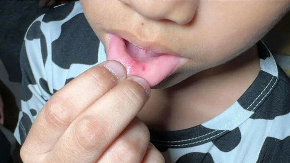 Bibir siswa SD ditusuk peniti oleh gurunya
