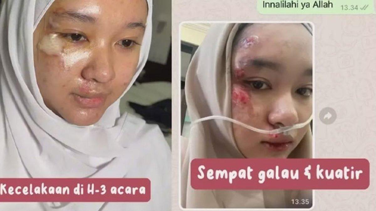 Calon pengantin kecelakaan jelang hari nikahan, untung bisa ditutup make up